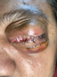MY JOURNEY WITH A RARE TUMOUR BEHIND EYE 79 IMG 4900