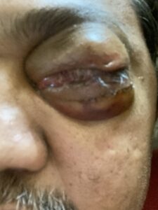 MY JOURNEY WITH A RARE TUMOUR BEHIND EYE 78 IMG 4901