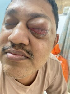 MY JOURNEY WITH A RARE TUMOUR BEHIND EYE 77 IMG 5002