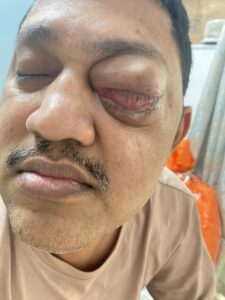 MY JOURNEY WITH A RARE TUMOUR BEHIND EYE 76 IMG 5003
