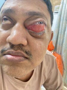 MY JOURNEY WITH A RARE TUMOUR BEHIND EYE 75 IMG 5004