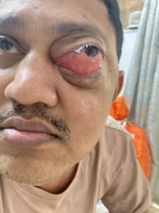 MY JOURNEY WITH A RARE TUMOUR BEHIND EYE 74 IMG 5005