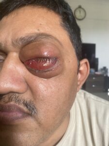 MY JOURNEY WITH A RARE TUMOUR BEHIND EYE 72 IMG 5042