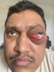 MY JOURNEY WITH A RARE TUMOUR BEHIND EYE 71 IMG 5044