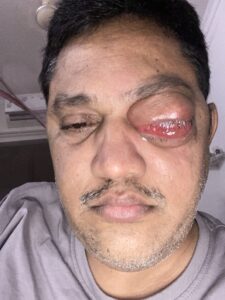 MY JOURNEY WITH A RARE TUMOUR BEHIND EYE 69 IMG 5084