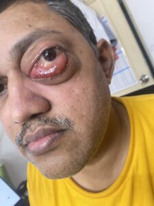 MY JOURNEY WITH A RARE TUMOUR BEHIND EYE 68 IMG 5324