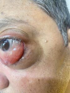 MY JOURNEY WITH A RARE TUMOUR BEHIND EYE 67 IMG 5326