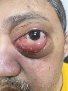 MY JOURNEY WITH A RARE TUMOUR BEHIND EYE 66 IMG 5327