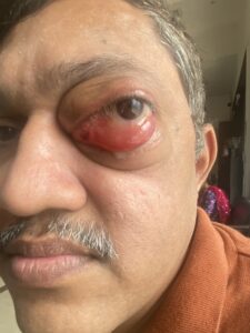 MY JOURNEY WITH A RARE TUMOUR BEHIND EYE 65 IMG 5510