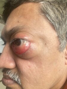 MY JOURNEY WITH A RARE TUMOUR BEHIND EYE 64 IMG 5511
