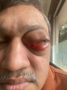 MY JOURNEY WITH A RARE TUMOUR BEHIND EYE 63 IMG 5512