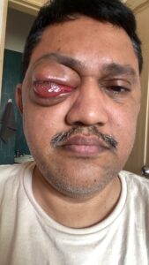 MY JOURNEY WITH A RARE TUMOUR BEHIND EYE 70 TGRT3659